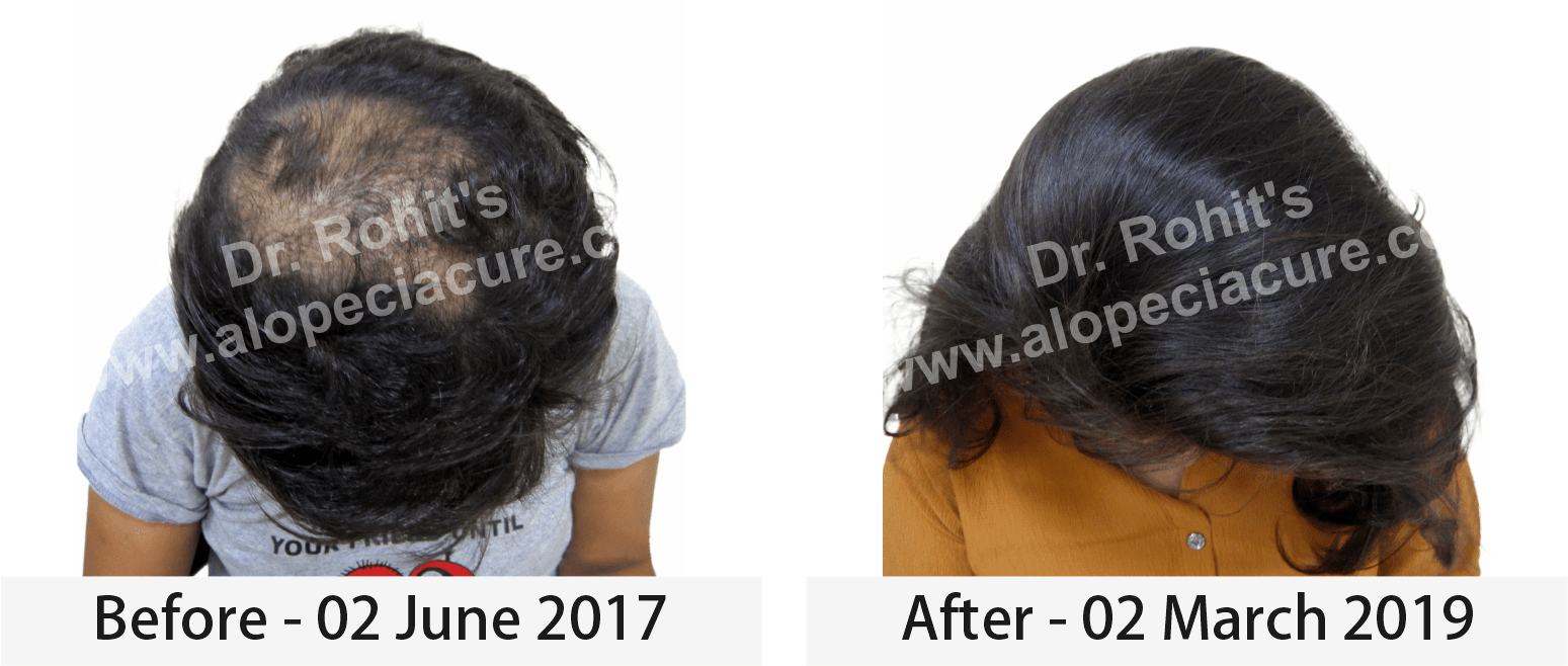 hair loss treatment